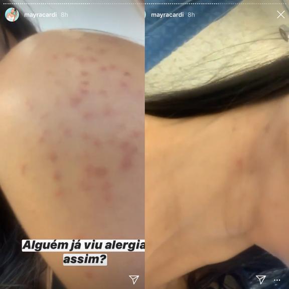 Mayra Cardi choca seguidores com evolução de alergia emocional