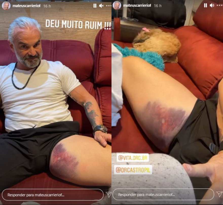 Mateus Carrieri mostra edema na perna após sofrer acidente