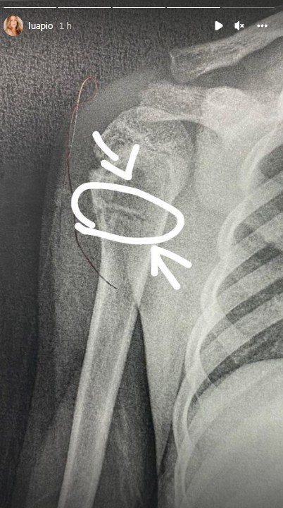 Luana Piovani mostra radiografia de Dom, que fraturou o ombro andando de skate