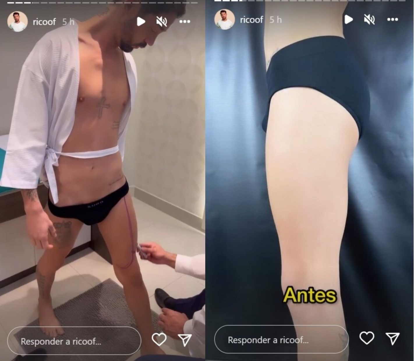 Rico Melquiades mostra procedimentos estéticos (Reprodução/Instagram)