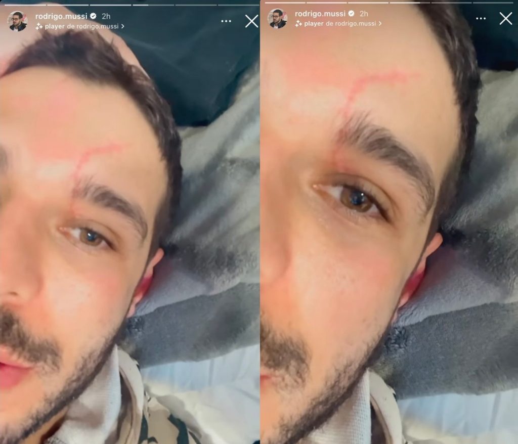 Rodrigo Mussi mostra cicatriz do acidente (Reprodução/Instagram)
