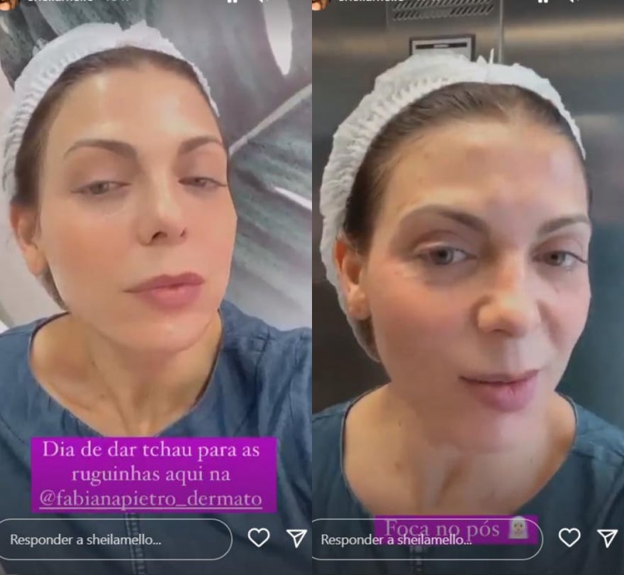 Sheila Mello mostra antes e depois de procedimento estético