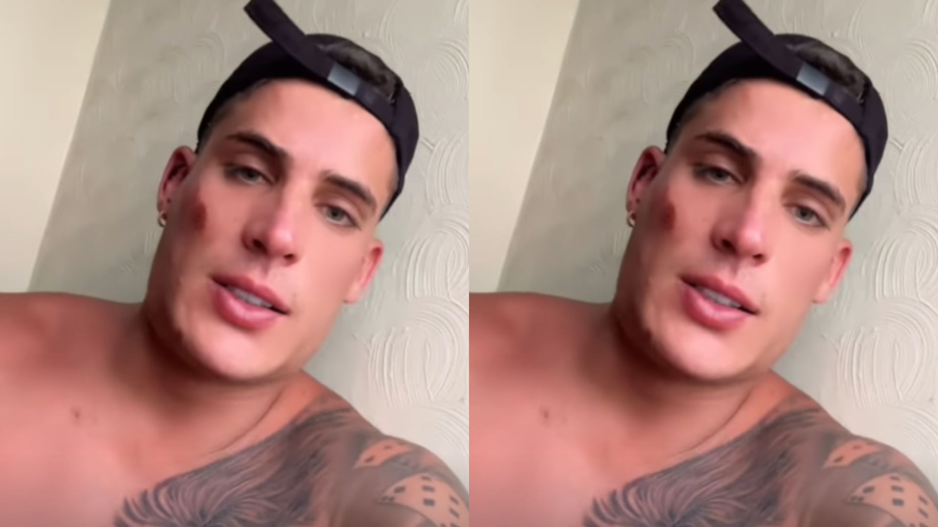 Tiago Ramos com rosto machucado após briga. Reprodução/Instagram