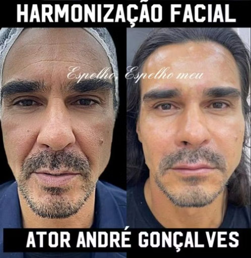 Antes e depois de André Gonçalves (Reprodução/Instagram)